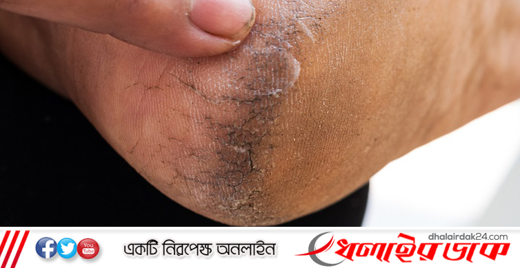 পা ফাটা মারাত্মক রোগের লক্ষণ নয় তো?