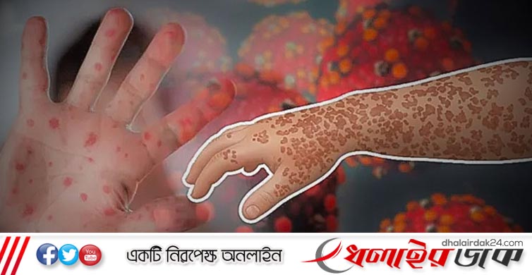 হাম ও উপসর্গ নিয়ে আরও ৮ শিশুর মৃত্যু